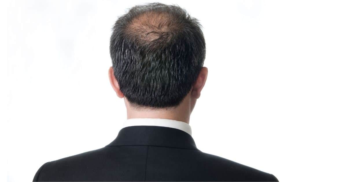 Back of a balding man's head