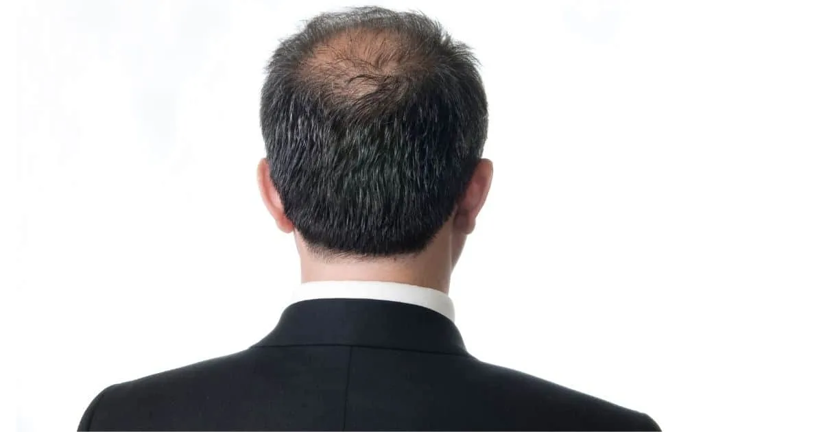 Back of a balding man's head